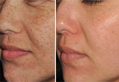 Woman with clear, even skin tone after IPL Lumecca photofacial at SkinScience Clinic Calgary - SkinScience