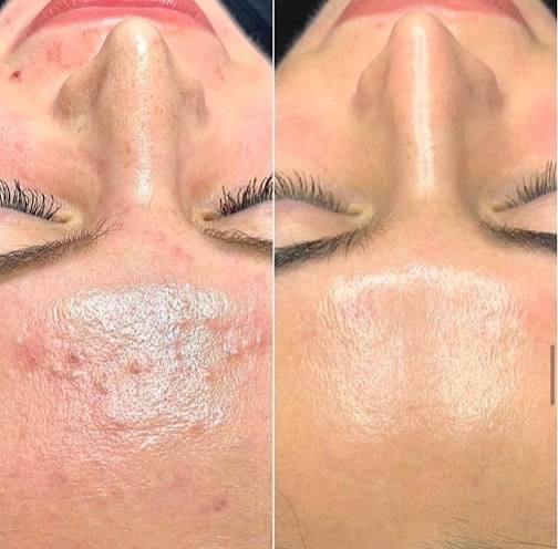Woman with refreshed, smooth skin after Erbium laser resurfacing at SkinScience Clinic Calgary - SkinScience