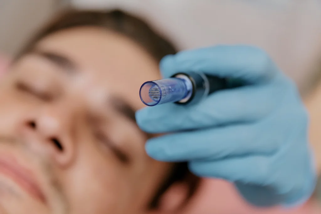 Close-up of skin showing improved texture and reduced scarring after microneedling sessions - SkinScience Close-up of skin showing improved texture and reduced scarring after microneedling sessions - SkinScience
