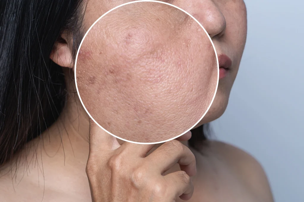 Woman with clear, radiant skin after collagen induction microneedling at SkinScience Calgary - SkinScience Woman with clear, radiant skin after collagen induction microneedling at SkinScience Calgary - SkinScience