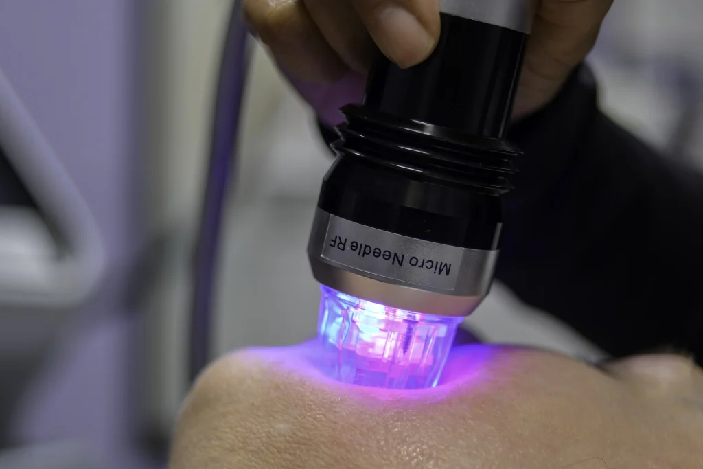 RF microneedling device delivering radiofrequency energy to tighten and remodel facial skin - SkinScience