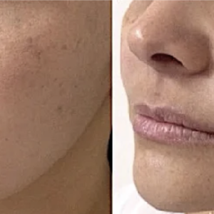 Before-and-after close-up of a woman's lower cheek showing smoother skin on the right; arrow highlights the improvement area. - SkinScience