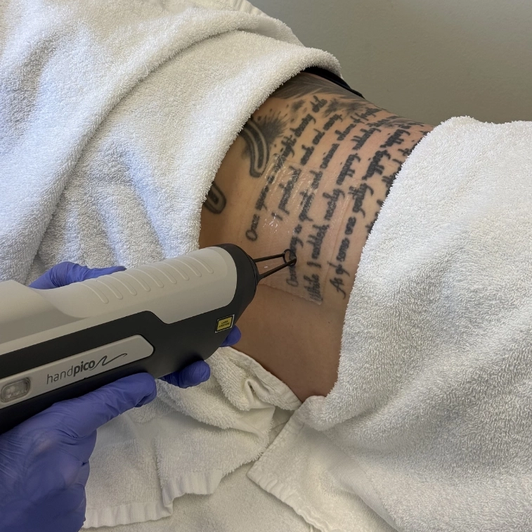 Laser tattoo removal session on a script tattoo across a patient's upper back at SkinScience Calgary - SkinScience Laser tattoo removal session on a script tattoo across a patient's upper back at SkinScience Calgary - SkinScience