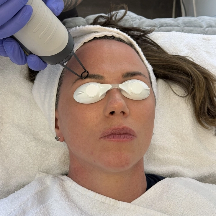 Clinician using a laser to treat cosmetic brow pigment while the patient wears protective eye shields - SkinScience Clinician using a laser to treat cosmetic brow pigment while the patient wears protective eye shields - SkinScience